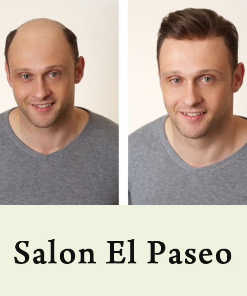 hair replacement systems Image